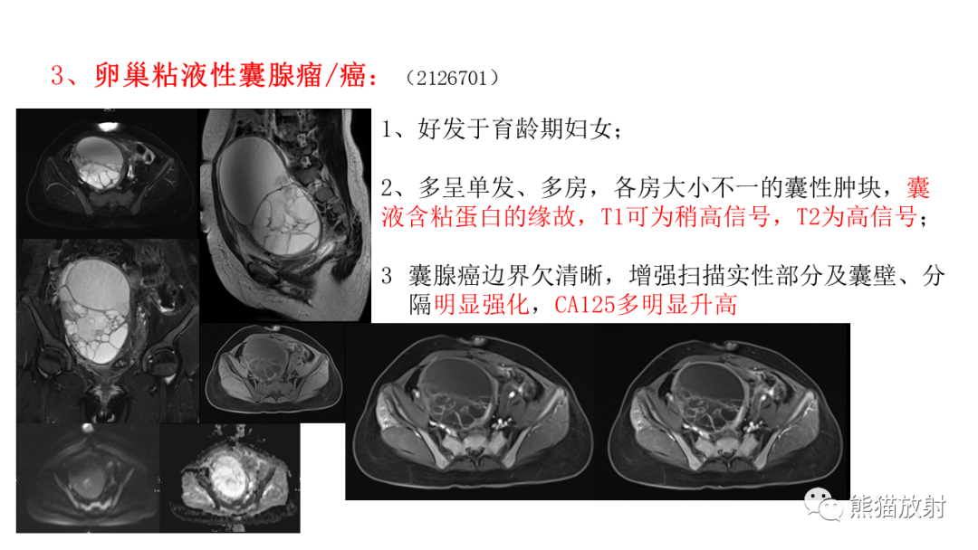 影像PPT - 【病例】卵巢卵泡膜纤维瘤2例MR影像-41