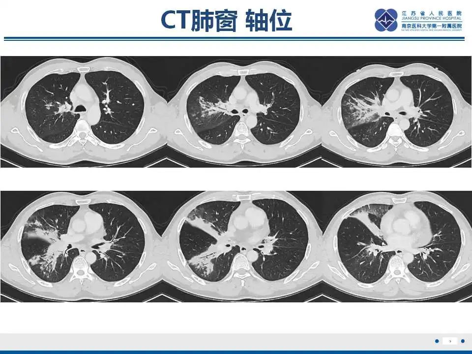 影像PPT - 【PPT】纤维素性纵隔炎-4