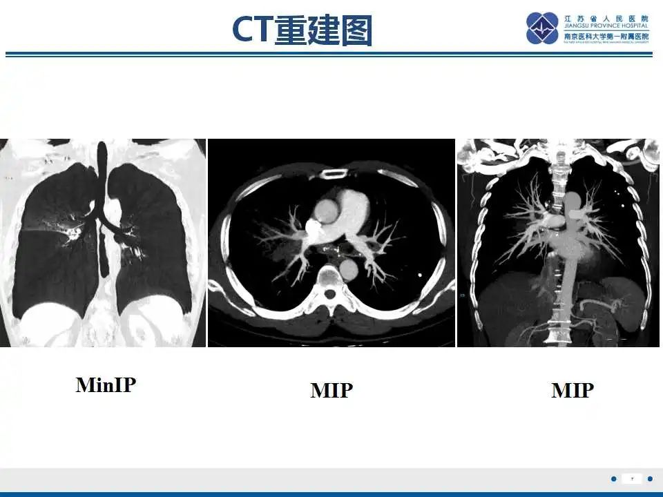 影像PPT - 【PPT】纤维素性纵隔炎-8