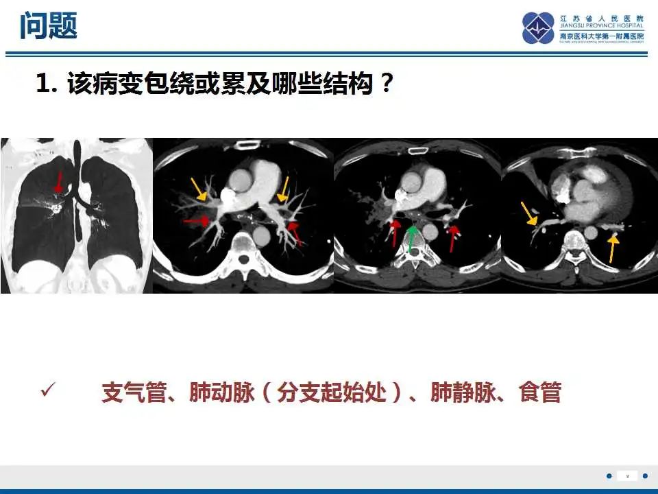影像PPT - 【PPT】纤维素性纵隔炎-10