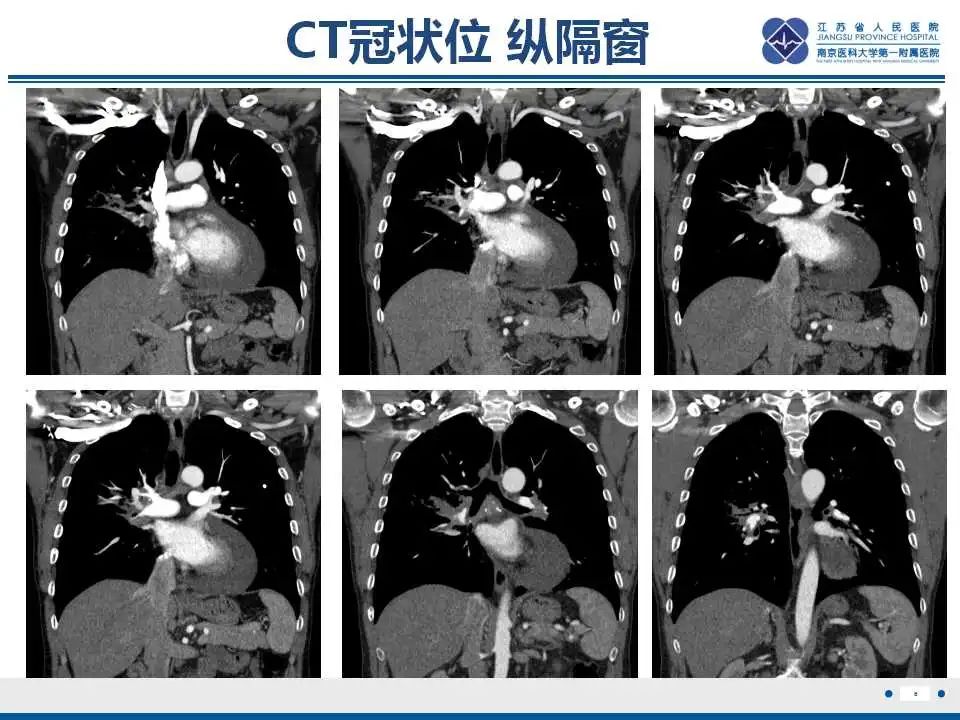 影像PPT - 【PPT】纤维素性纵隔炎-7