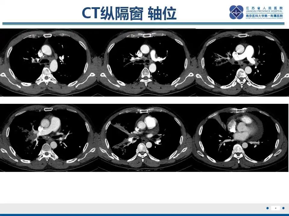 影像PPT - 【PPT】纤维素性纵隔炎-5