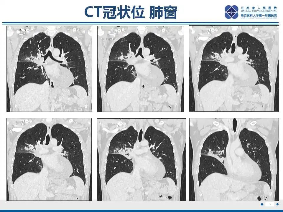 影像PPT - 【PPT】纤维素性纵隔炎-6