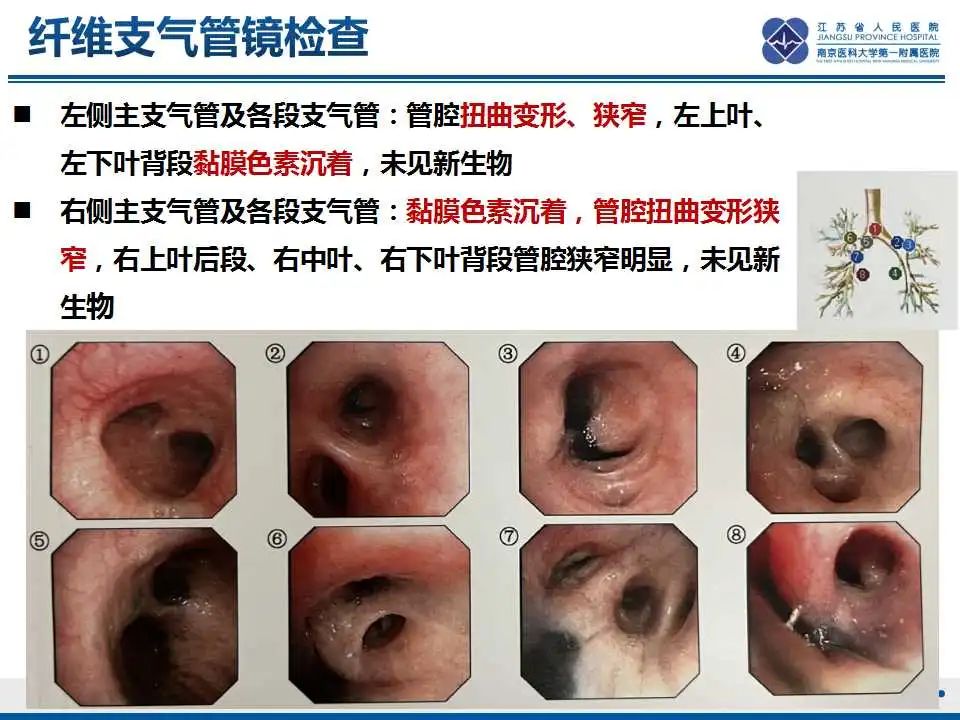 影像PPT - 【PPT】纤维素性纵隔炎-17
