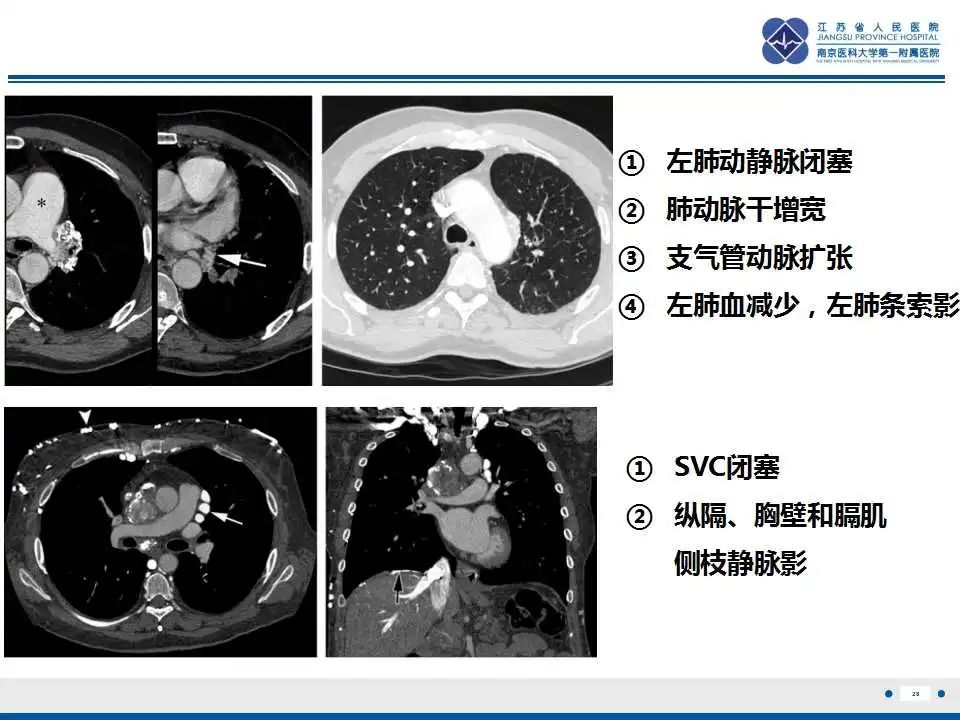 影像PPT - 【PPT】纤维素性纵隔炎-29
