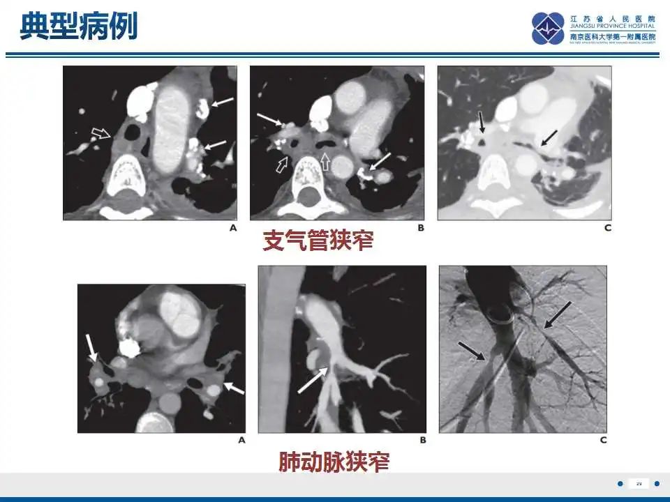 影像PPT - 【PPT】纤维素性纵隔炎-30