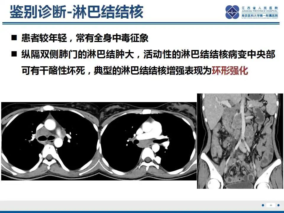 影像PPT - 【PPT】纤维素性纵隔炎-34