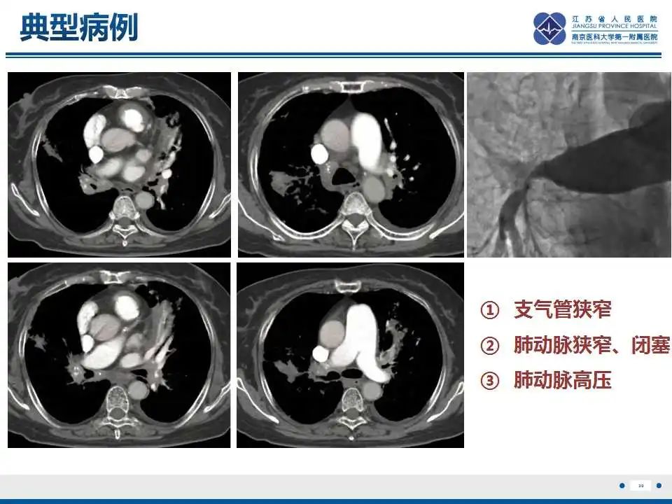 影像PPT - 【PPT】纤维素性纵隔炎-31