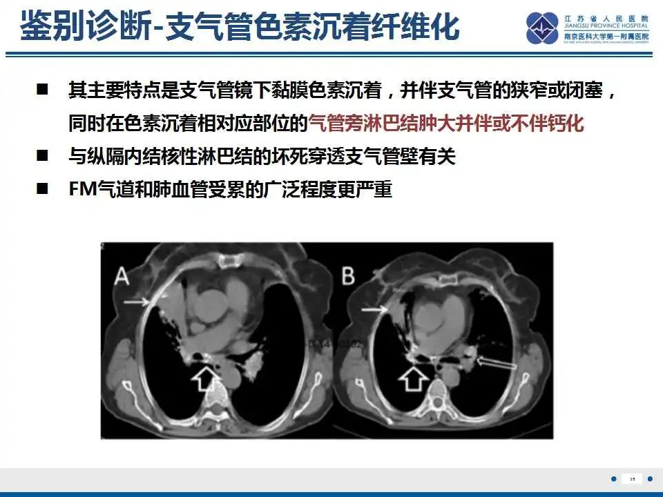 影像PPT - 【PPT】纤维素性纵隔炎-36