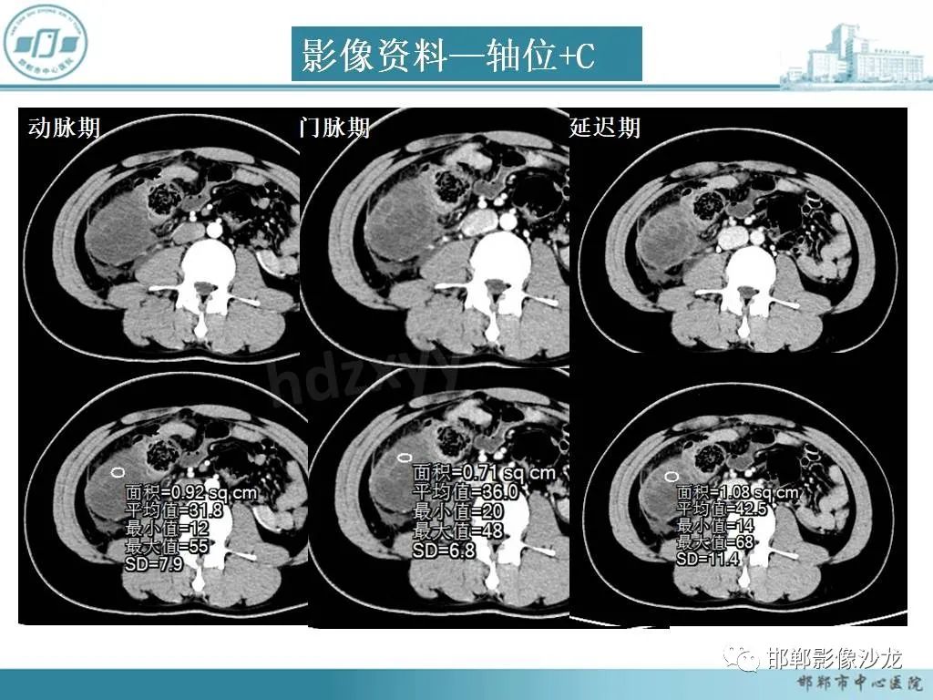 影像PPT - 【PPT】良性多囊性腹膜间皮瘤影像诊断-2