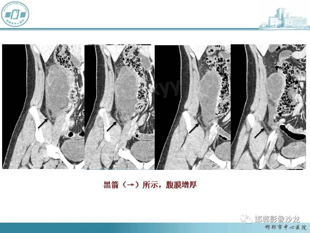 影像PPT - 【PPT】良性多囊性腹膜间皮瘤影像诊断-6