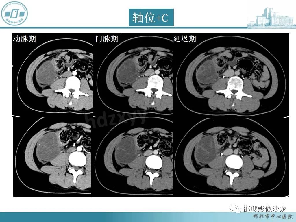 影像PPT - 【PPT】良性多囊性腹膜间皮瘤影像诊断-3