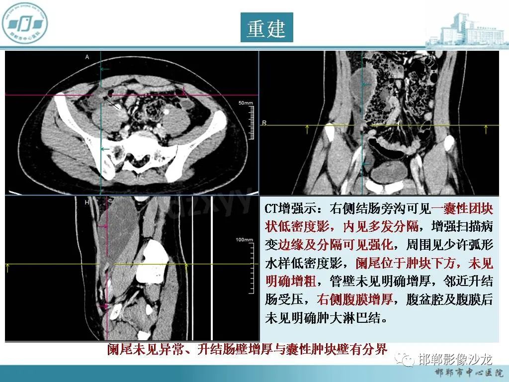 影像PPT - 【PPT】良性多囊性腹膜间皮瘤影像诊断-5