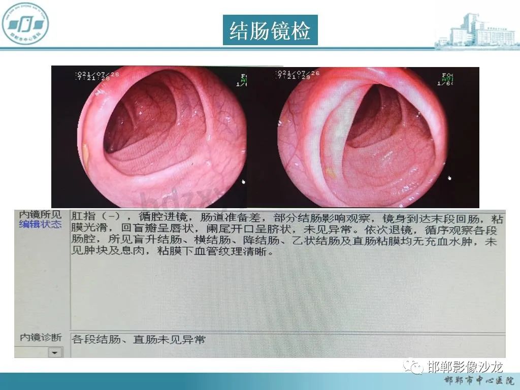 影像PPT - 【PPT】良性多囊性腹膜间皮瘤影像诊断-7