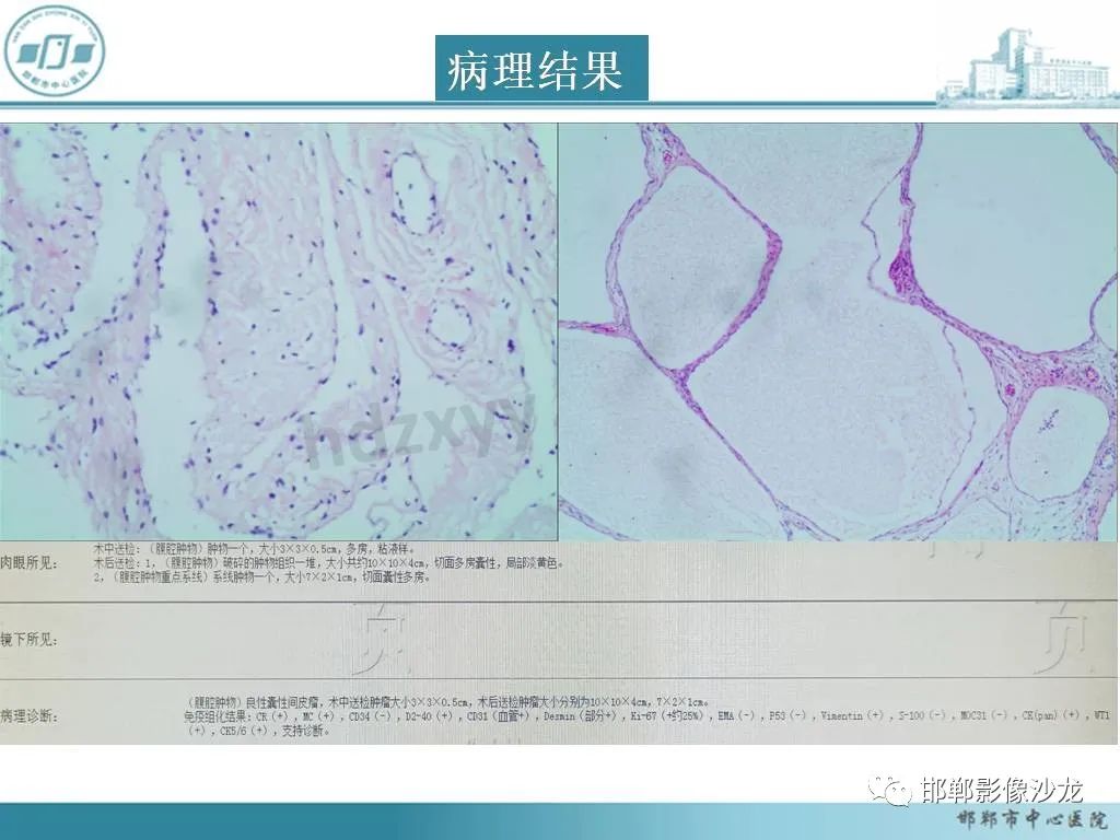 影像PPT - 【PPT】良性多囊性腹膜间皮瘤影像诊断-8