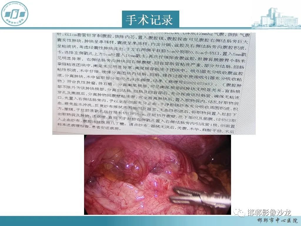 影像PPT - 【PPT】良性多囊性腹膜间皮瘤影像诊断-9