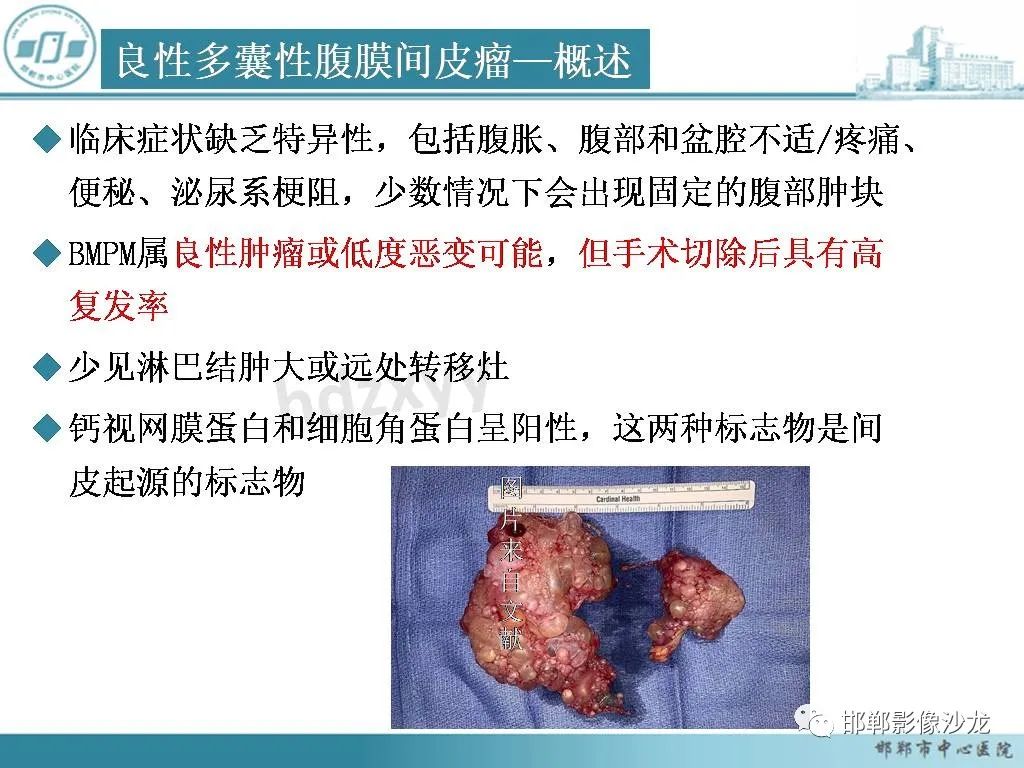 影像PPT - 【PPT】良性多囊性腹膜间皮瘤影像诊断-13