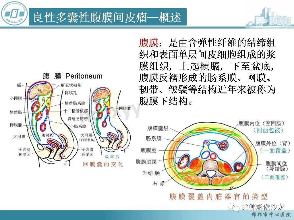 影像PPT - 【PPT】良性多囊性腹膜间皮瘤影像诊断-14