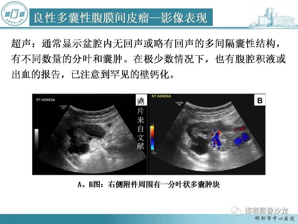 影像PPT - 【PPT】良性多囊性腹膜间皮瘤影像诊断-16