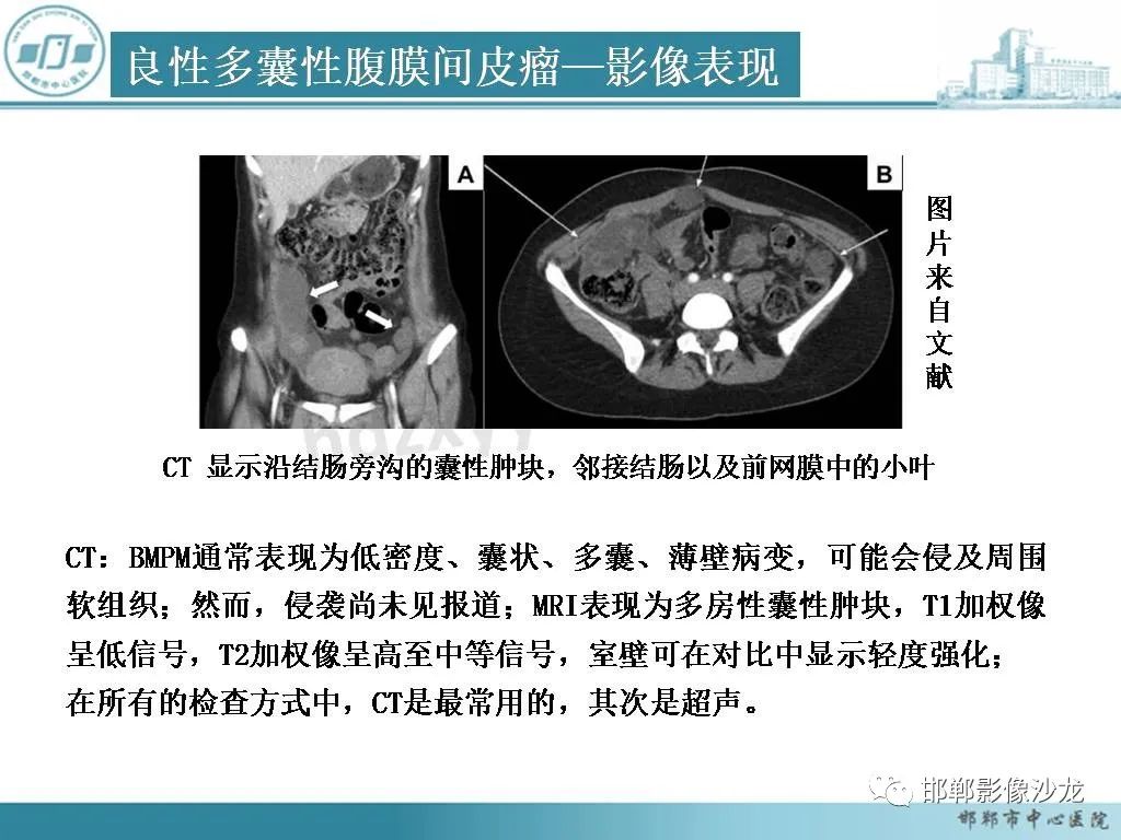 影像PPT - 【PPT】良性多囊性腹膜间皮瘤影像诊断-17
