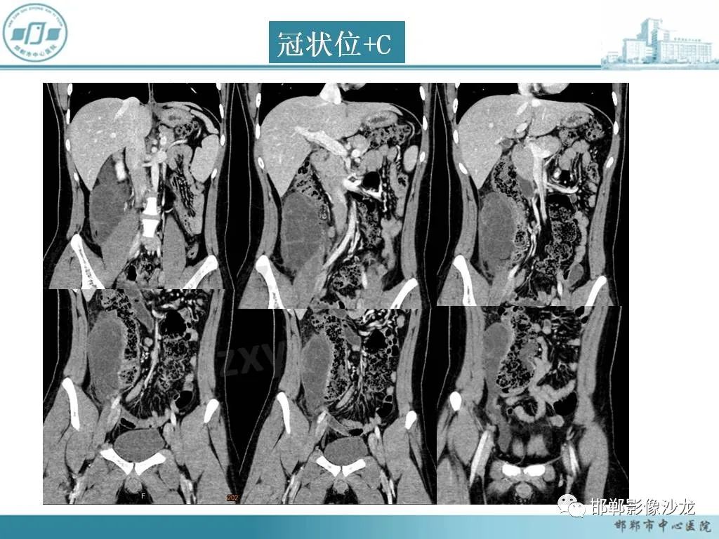 影像PPT - 【PPT】良性多囊性腹膜间皮瘤影像诊断-4