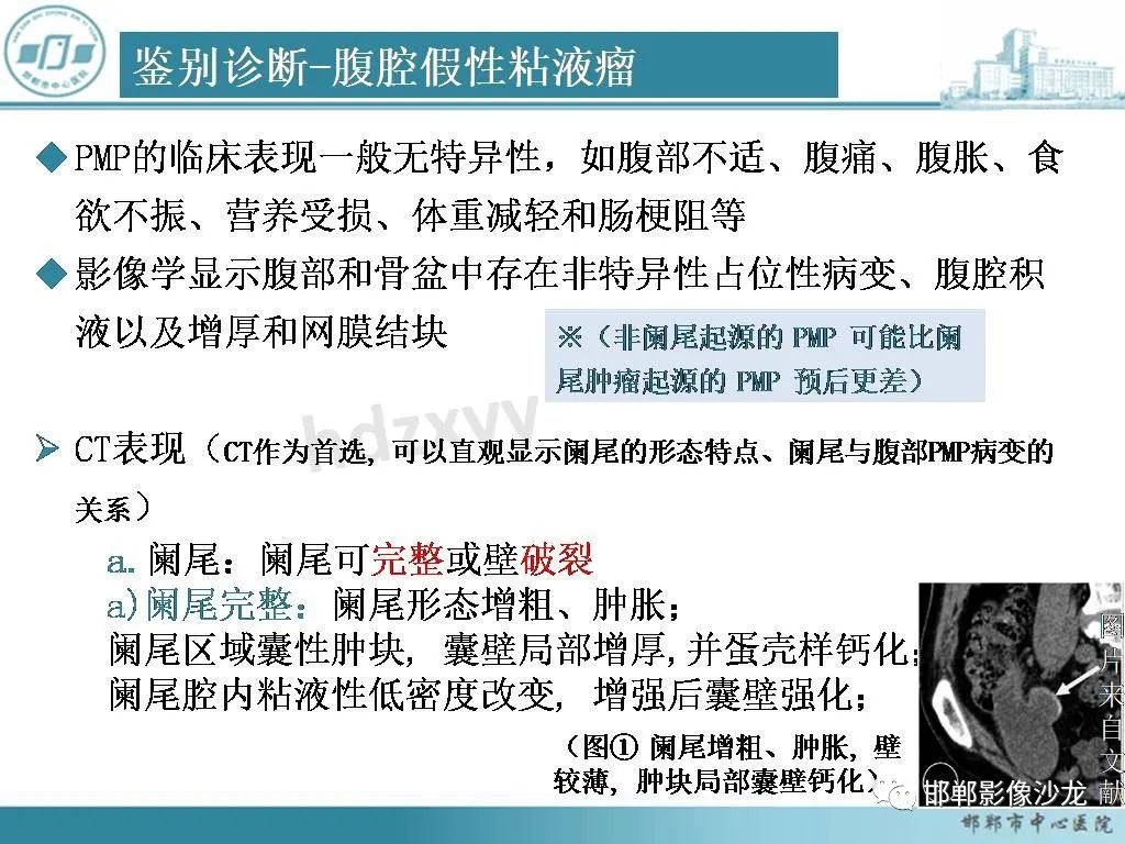 影像PPT - 【PPT】良性多囊性腹膜间皮瘤影像诊断-22