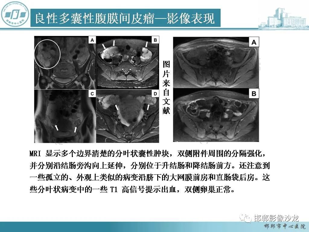 影像PPT - 【PPT】良性多囊性腹膜间皮瘤影像诊断-18