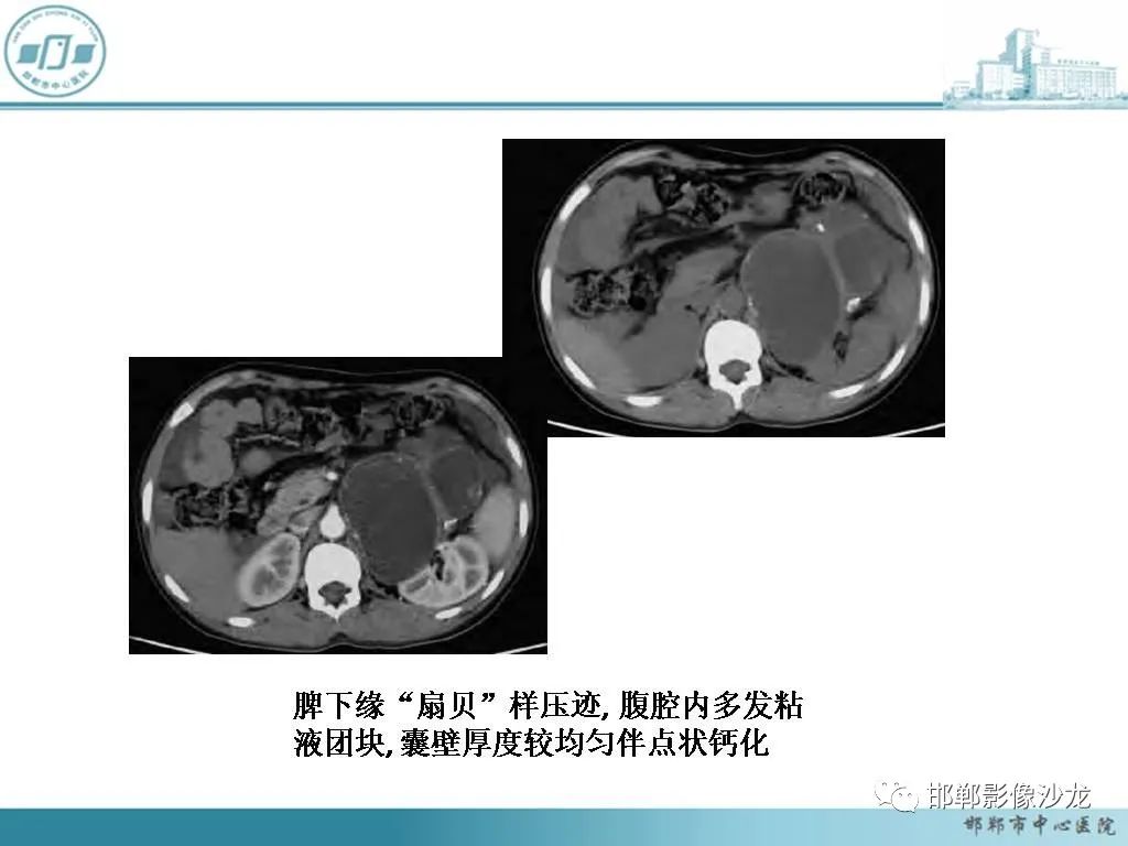 影像PPT - 【PPT】良性多囊性腹膜间皮瘤影像诊断-24