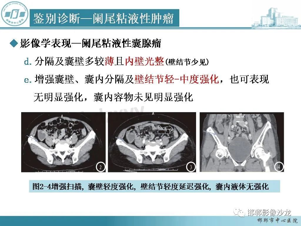 影像PPT - 【PPT】良性多囊性腹膜间皮瘤影像诊断-31