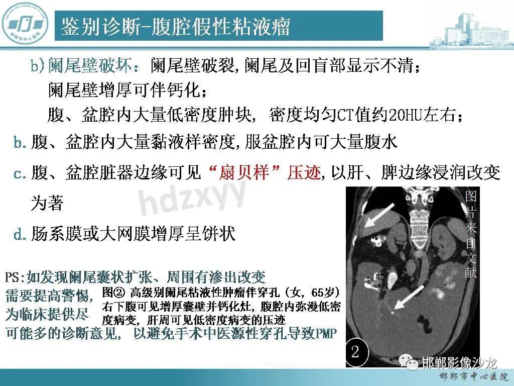 影像PPT - 【PPT】良性多囊性腹膜间皮瘤影像诊断-23