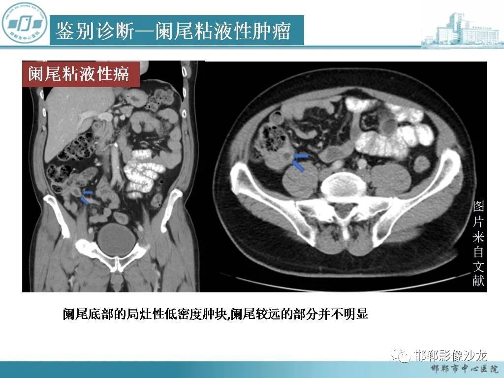 影像PPT - 【PPT】良性多囊性腹膜间皮瘤影像诊断-33