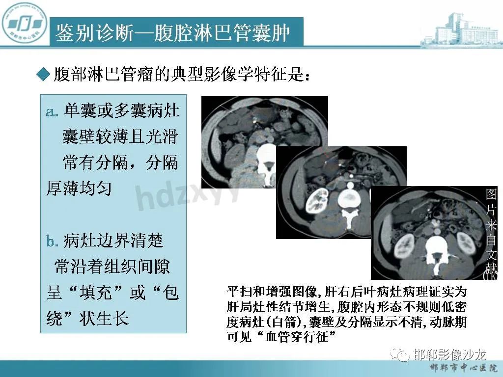 影像PPT - 【PPT】良性多囊性腹膜间皮瘤影像诊断-26