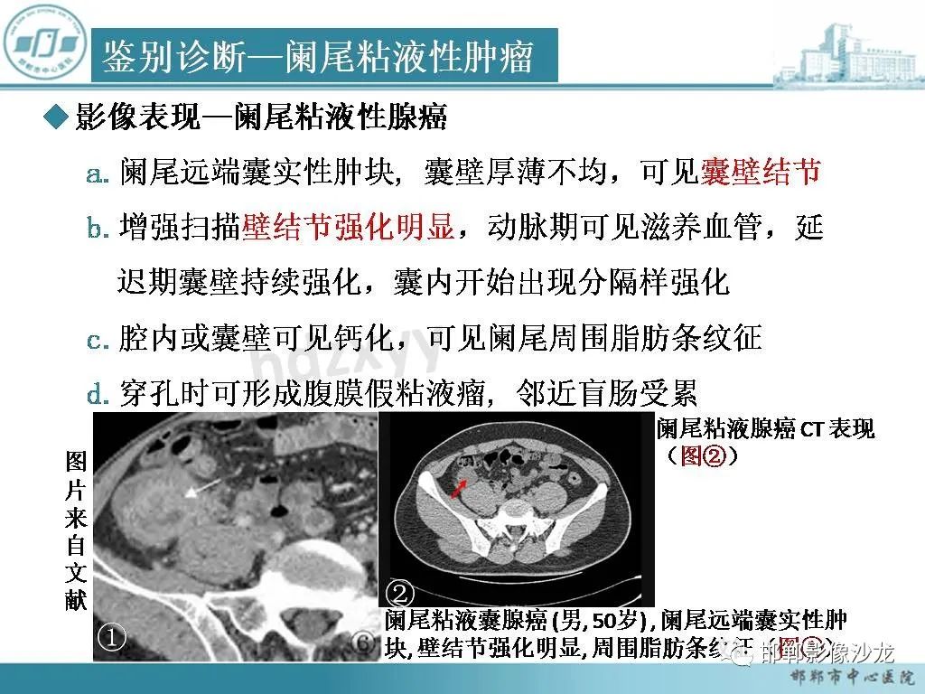 影像PPT - 【PPT】良性多囊性腹膜间皮瘤影像诊断-32