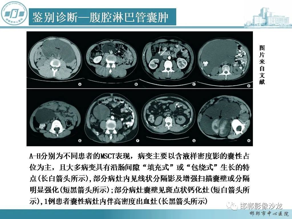 影像PPT - 【PPT】良性多囊性腹膜间皮瘤影像诊断-2