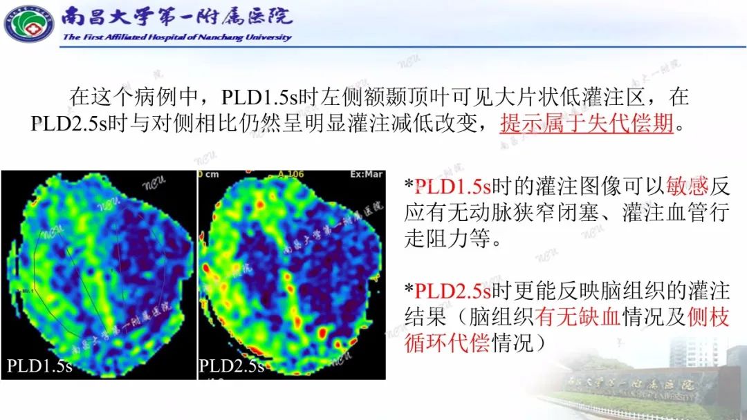 影像PPT - 【PPT】磁共振ASL成像原理及临床应用-12