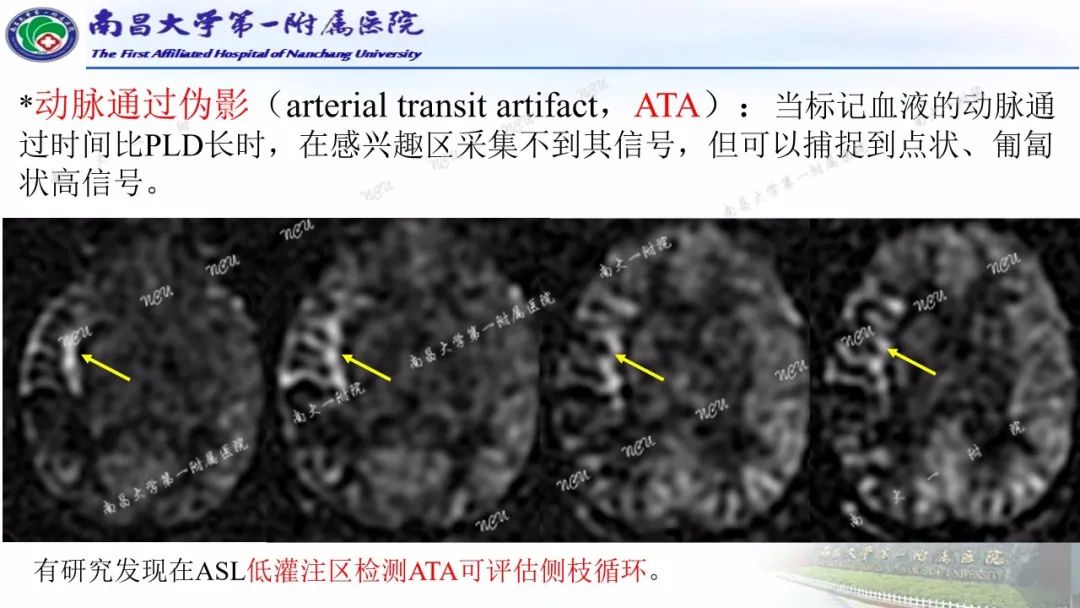 影像PPT - 【PPT】磁共振ASL成像原理及临床应用-13