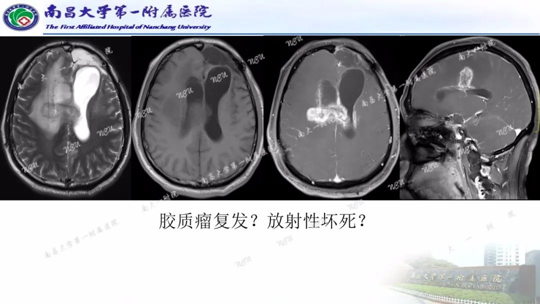 影像PPT - 【PPT】磁共振ASL成像原理及临床应用-20