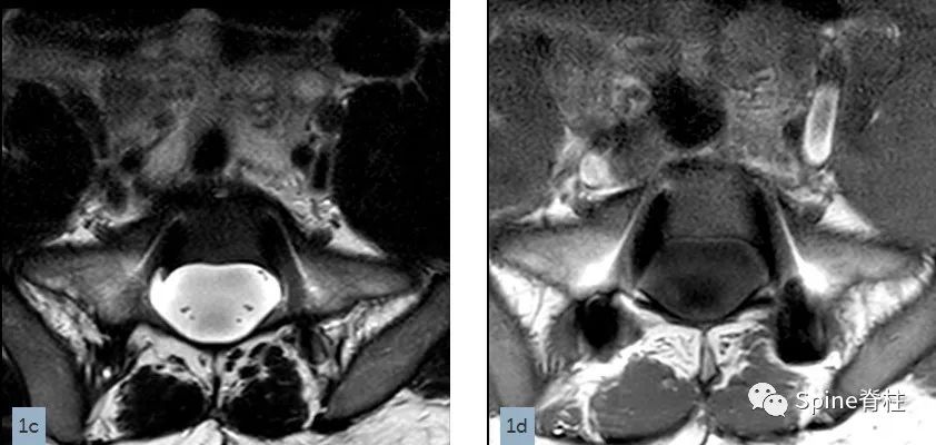 影像PPT - 【病例】硬膜扩张 (dural ectasia)1例MR影像-2 影像PPT - 【病例】硬膜扩张 (dural ectasia)1例MR影像-2