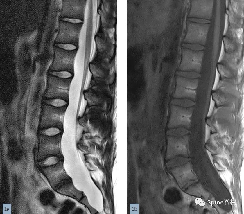 影像PPT - 【病例】硬膜扩张 (dural ectasia)1例MR影像-1 影像PPT - 【病例】硬膜扩张 (dural ectasia)1例MR影像-1