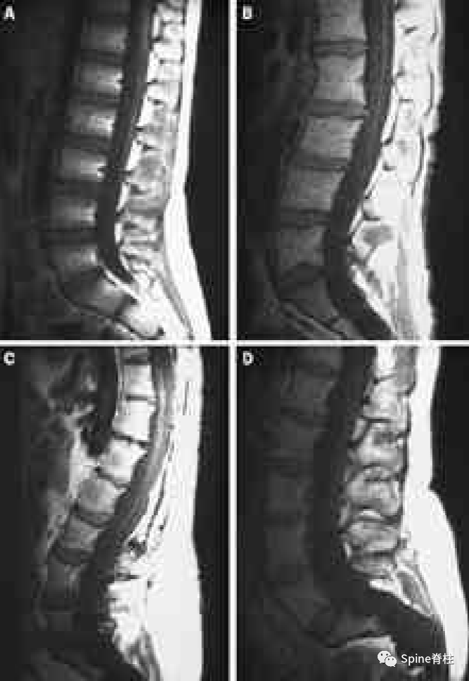 影像PPT - 【病例】硬膜扩张 (dural ectasia)1例MR影像-4 影像PPT - 【病例】硬膜扩张 (dural ectasia)1例MR影像-4