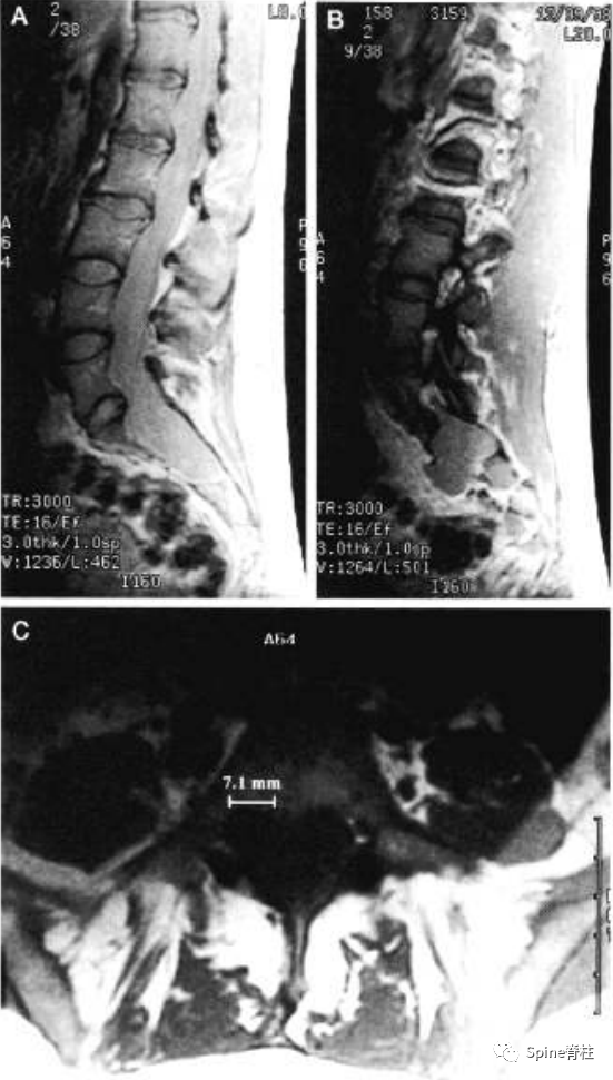 影像PPT - 【病例】硬膜扩张 (dural ectasia)1例MR影像-8 影像PPT - 【病例】硬膜扩张 (dural ectasia)1例MR影像-8