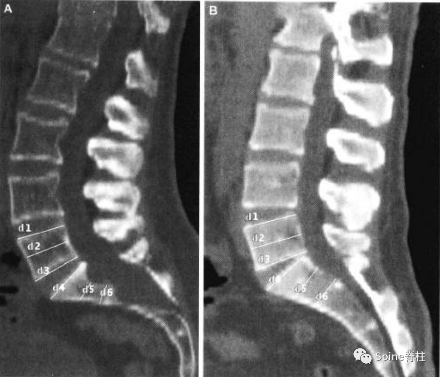 影像PPT - 【病例】硬膜扩张 (dural ectasia)1例MR影像-6 影像PPT - 【病例】硬膜扩张 (dural ectasia)1例MR影像-6