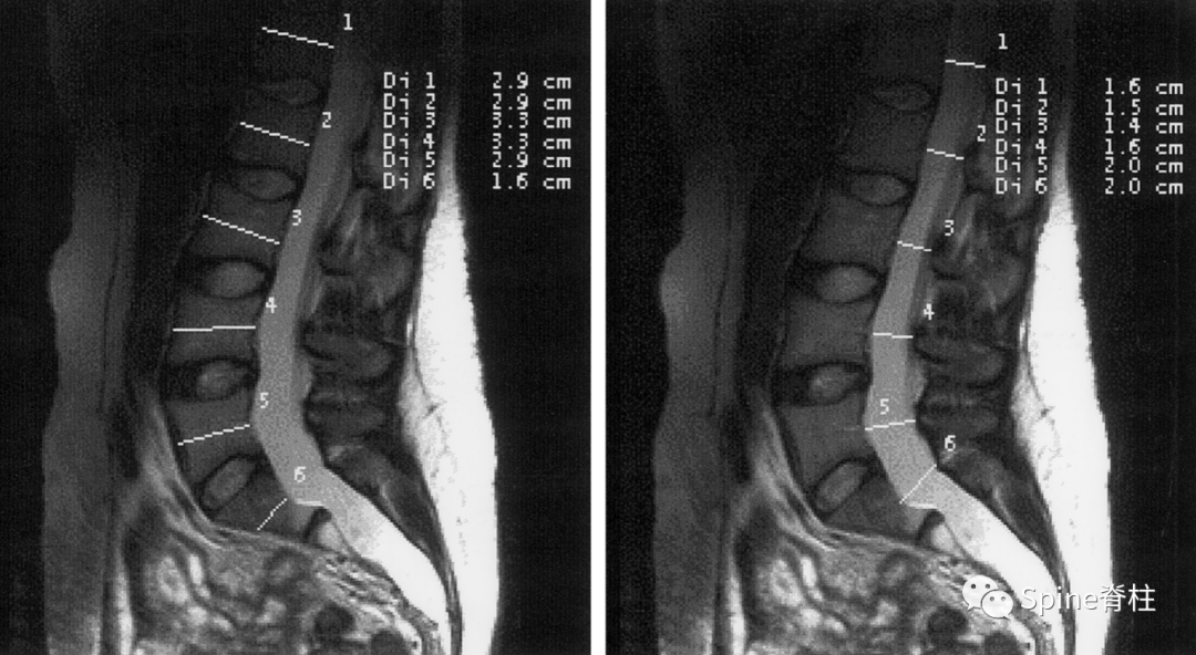 影像PPT - 【病例】硬膜扩张 (dural ectasia)1例MR影像-9 影像PPT - 【病例】硬膜扩张 (dural ectasia)1例MR影像-9