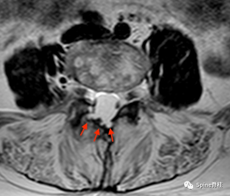 影像PPT - 【病例】硬膜扩张 (dural ectasia)1例MR影像-13 影像PPT - 【病例】硬膜扩张 (dural ectasia)1例MR影像-13