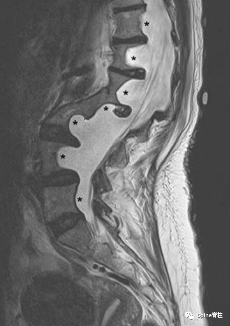 影像PPT - 【病例】硬膜扩张 (dural ectasia)1例MR影像-15 影像PPT - 【病例】硬膜扩张 (dural ectasia)1例MR影像-15