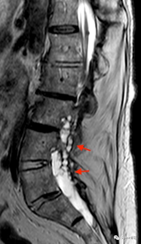 影像PPT - 【病例】硬膜扩张 (dural ectasia)1例MR影像-14 影像PPT - 【病例】硬膜扩张 (dural ectasia)1例MR影像-14