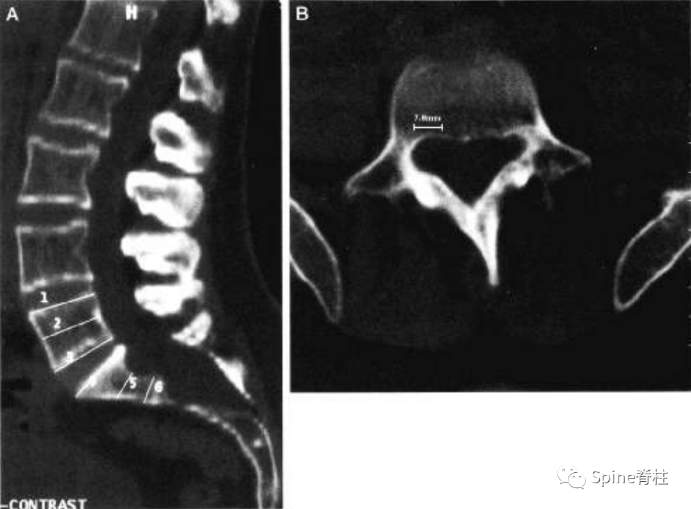 影像PPT - 【病例】硬膜扩张 (dural ectasia)1例MR影像-7 影像PPT - 【病例】硬膜扩张 (dural ectasia)1例MR影像-7