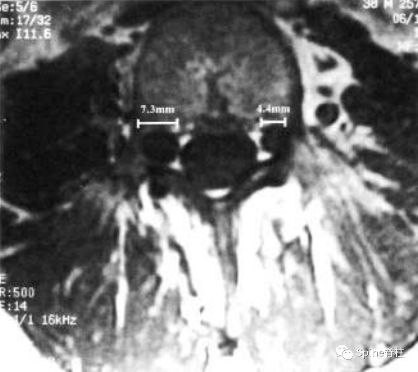 影像PPT - 【病例】硬膜扩张 (dural ectasia)1例MR影像-5 影像PPT - 【病例】硬膜扩张 (dural ectasia)1例MR影像-5