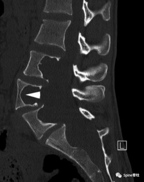 影像PPT - 【病例】硬膜扩张 (dural ectasia)1例MR影像-16 影像PPT - 【病例】硬膜扩张 (dural ectasia)1例MR影像-16