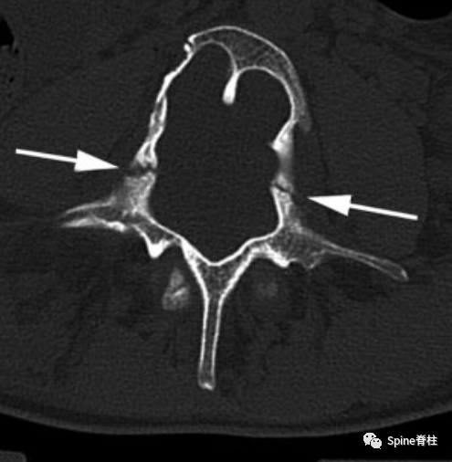 影像PPT - 【病例】硬膜扩张 (dural ectasia)1例MR影像-17 影像PPT - 【病例】硬膜扩张 (dural ectasia)1例MR影像-17
